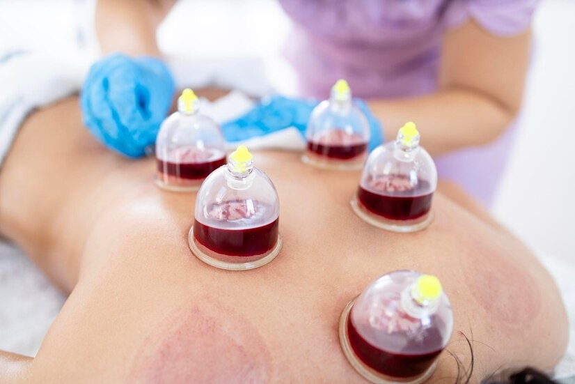 Wet Cupping Massage Hertfordshire